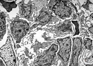 M,73y. | bone marrow - hairy cell leukemia M,73y. | bone marrow - hairy cell leukemia